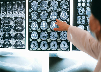 Huntington’s Disease Breakthrough: Gene Therapy AMT-130 and the Energy Failure Model