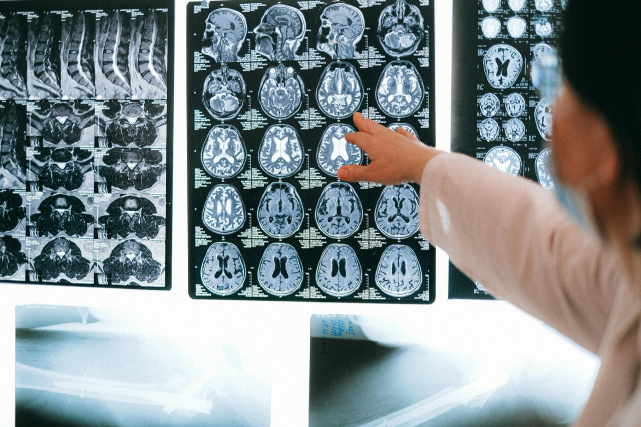 Huntington’s Disease Breakthrough: Gene Therapy AMT-130 and the Energy Failure Model
